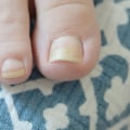 Expert Tips for Treating Thickened Toenails