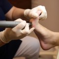 How to Remove Calluses From Feet Permanently With Podiatrist-Approved Methods