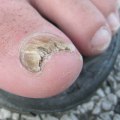 The Importance of Regular Toenail Care for the Elderly