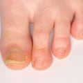 Expert Tips for Cutting Thick Toenails: A Podiatrist's Perspective