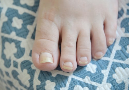 Expert Tips for Treating Thickened Toenails