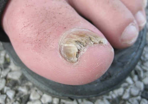 The Importance of Regular Toenail Care for the Elderly