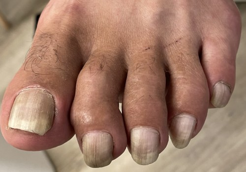 Expert Tips for Taking Care of Elderly Toenails