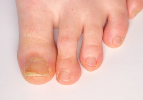 Expert Tips for Cutting Thick Toenails: A Podiatrist's Perspective