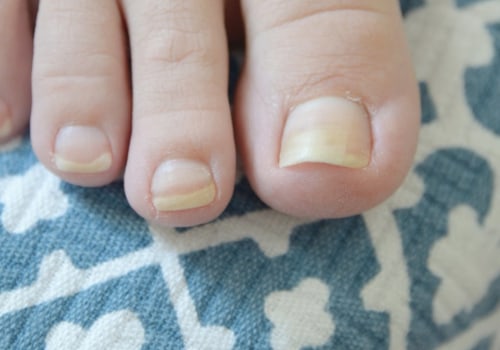 Expert Tips for Treating Thick Toenails: A Podiatrist's Perspective